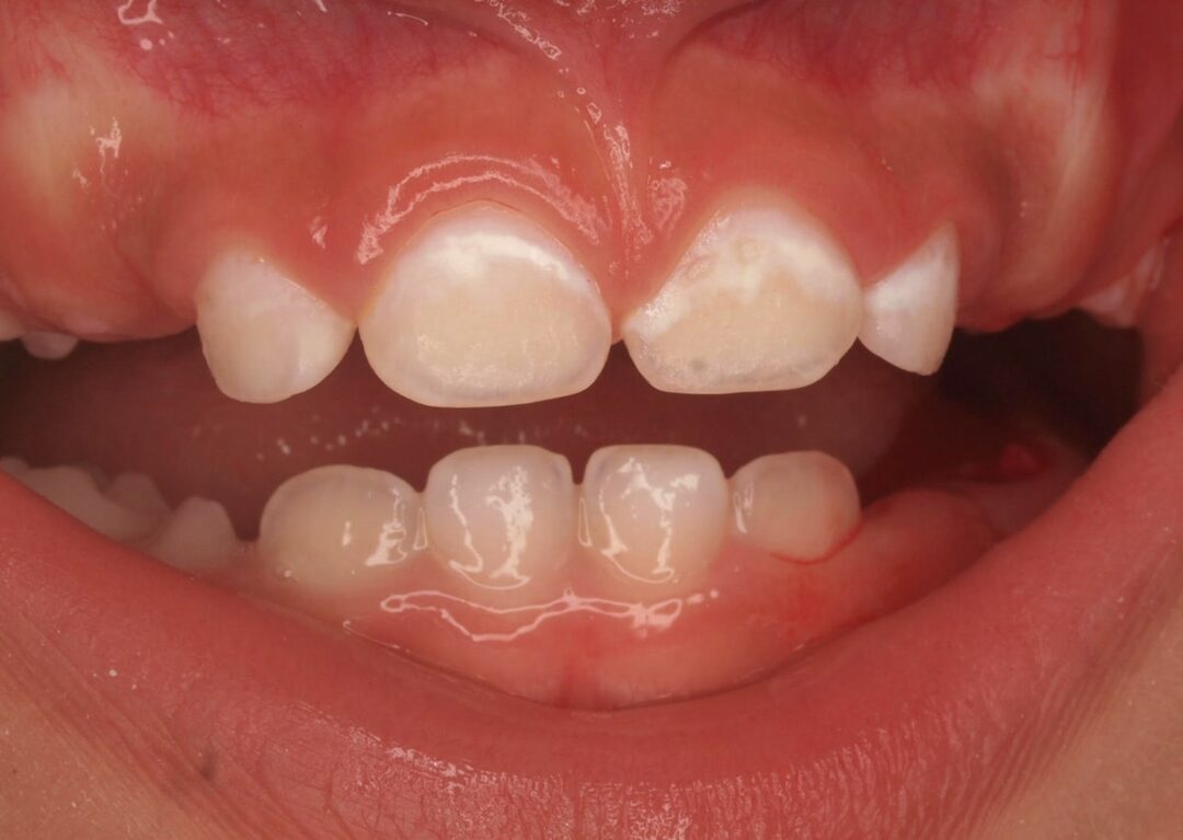 Mi hijo no se deja lavar los dientes {Evita la CARIES} 👶 | Victòria